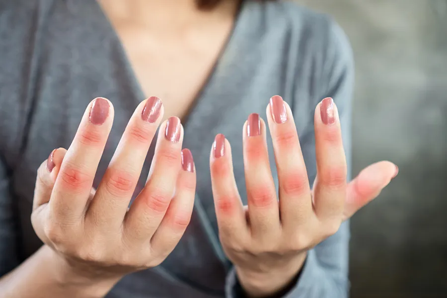 Lupus-Clinic Close-up of the hands of a woman in a gray shirt, with swollen, red knuckles. Get treatment for Lupus from AZENA Health & Longevity in Gainesville.