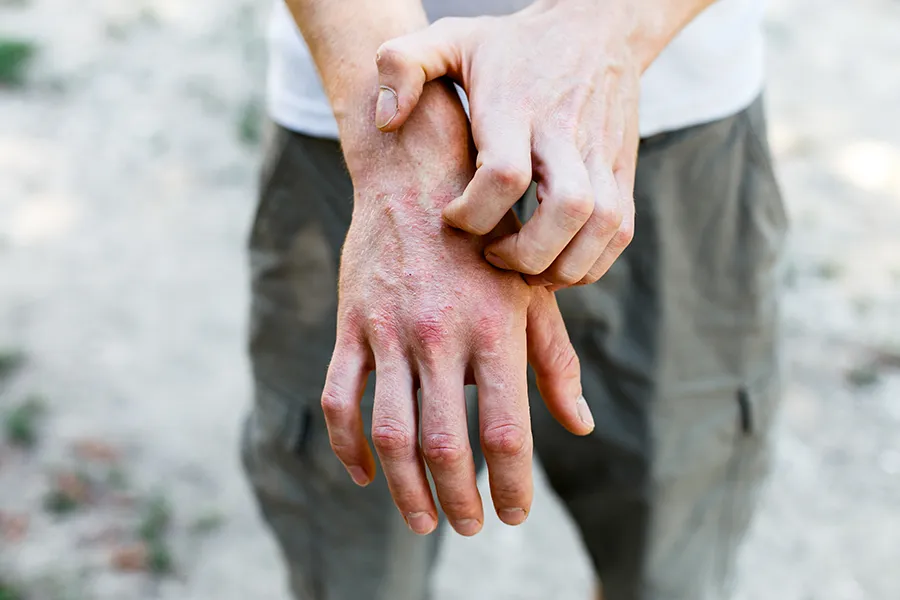 Psoriasis-Clinic Close-up of a man scratching his hands while experiencing Psoriasis. Get care for Psoriasis from AZENA Health & Longevity in Gainesville.