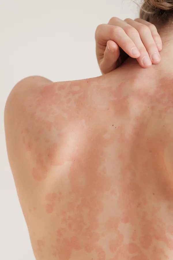 Psoriasis-Treatment The back and shoulder of a woman experiencing Psoriasis. Get treatment for Psoriasis from AZENA Health & Longevity in Gainesville.