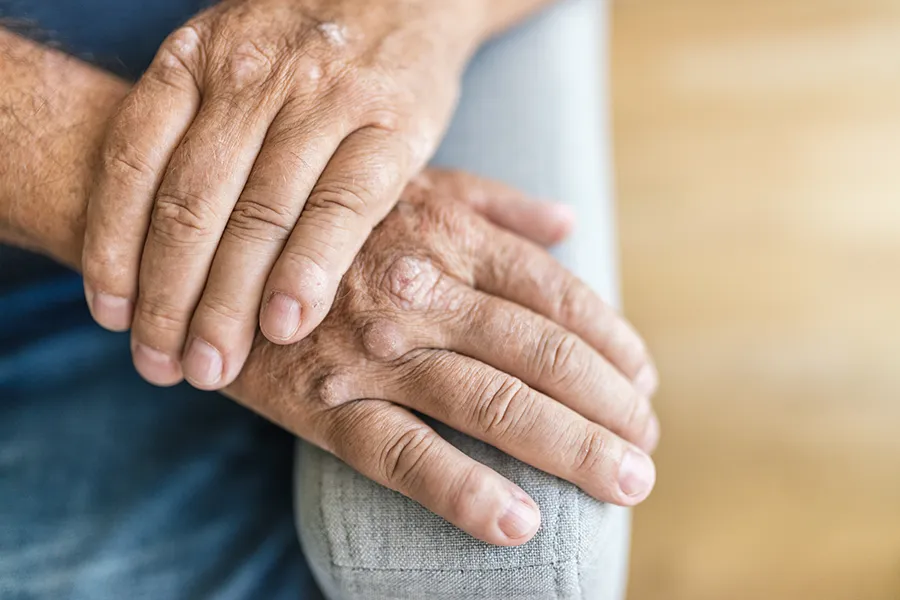 Psoriatic-Arthritis-Clinic Close-up of a mature mans hands showing signs of psoriatic arthritis. Get treatment for psoriatic arthritis from AZENA Health & Longevity in Gainesville.