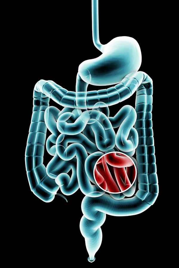 Ulcerative-Colitis-Treatment 3D illustration of the digestive system in blue tones, with an area of discomfort in red tones. Get treatment for Ulcerative Colitis from AZENA Health & Longevity in Gainesville.